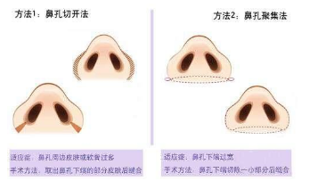 鼻翼整形