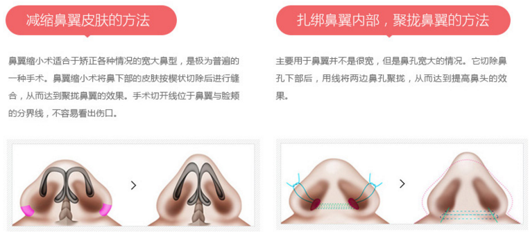 南京做鼻翼缩小手术留疤严重吗?