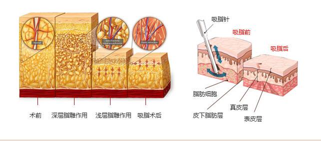 手臂太粗用什么方法减肥好?