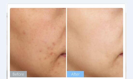 光子美白嫩肤的适应人群有哪些?