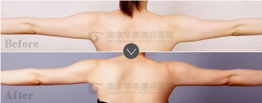 南京手臂吸脂的费用是多少?
