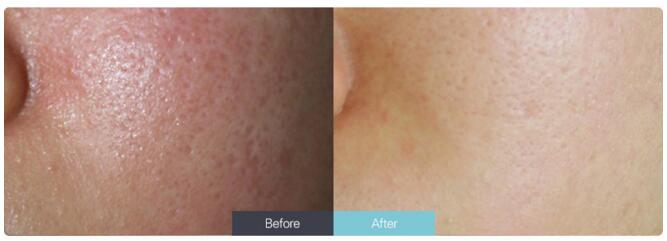 南京做激光收缩毛孔后怎么护肤