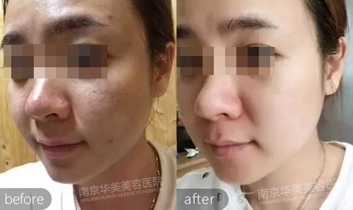 南京毛孔大能缩小吗